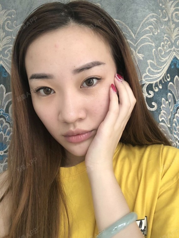 埋线提升好不好_效果图_小昕怡埋线提升术后第12天_新图片