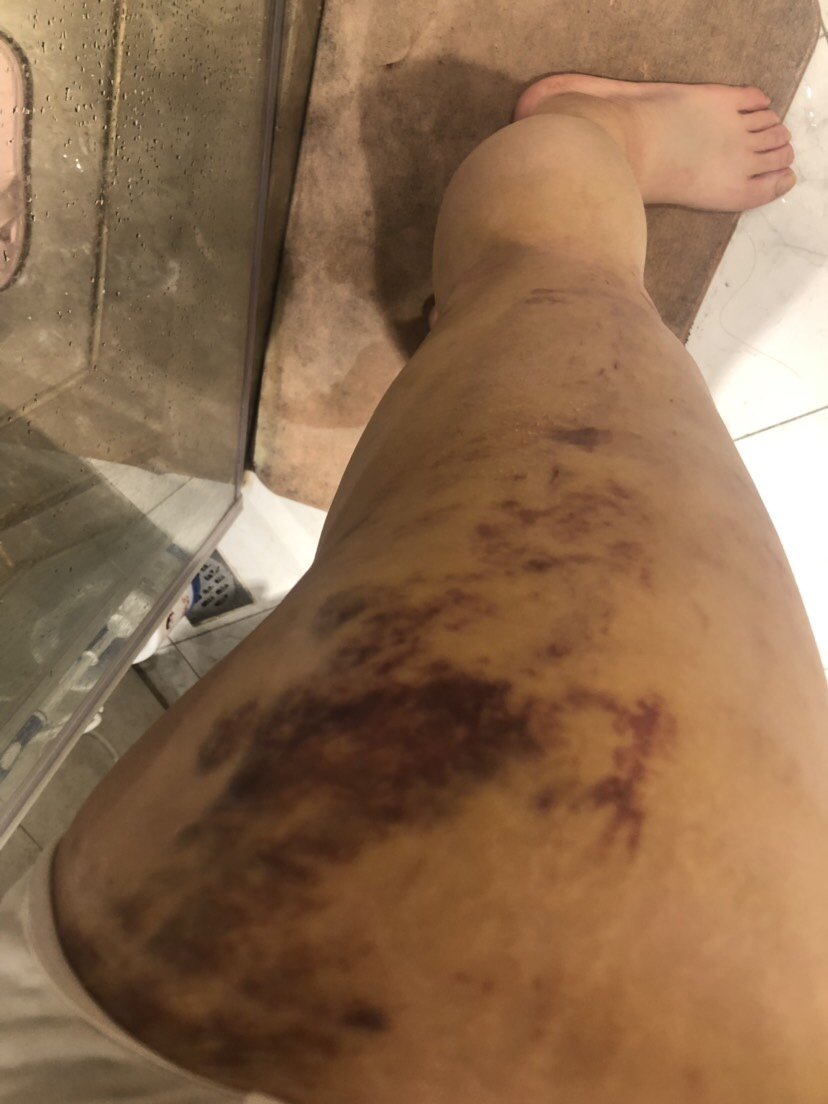 吸脂瘦大腿第7天