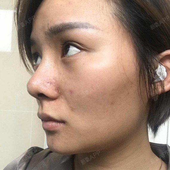 耳软骨复合隆鼻好不好_效果图_nananany耳软骨复合术7