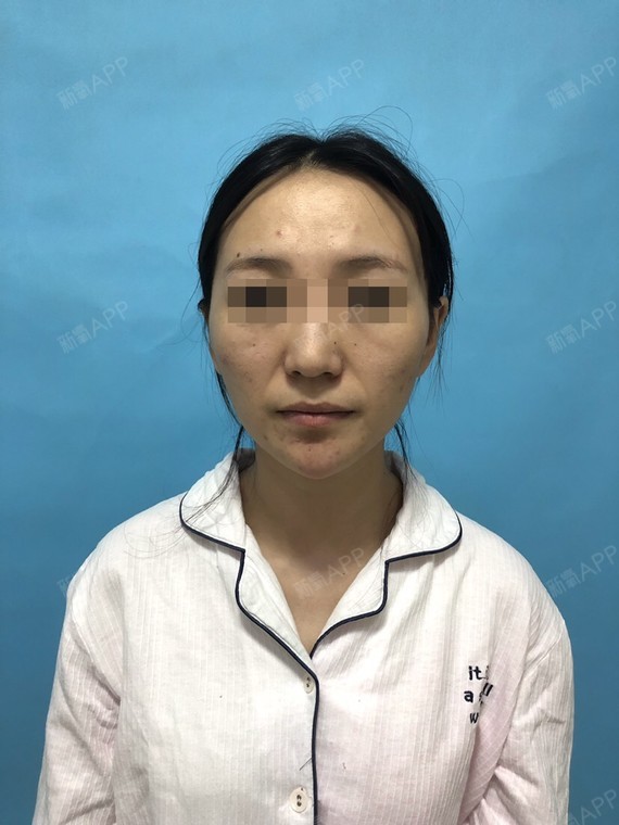 为了我这颧骨高凸的脸型问题我真的是愁了好久,以前