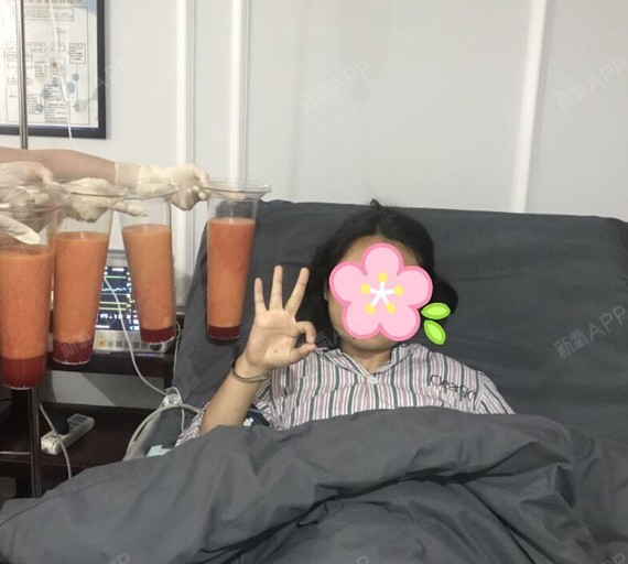 威塑吸脂 四大杯满满得脂肪 刘医生帮我抽得干干净净的!
