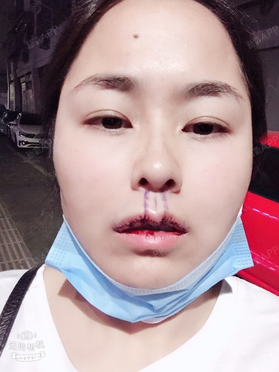 m唇手术