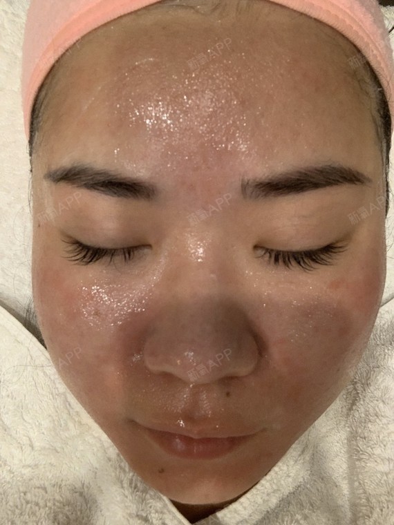 敷完麻药就过敏