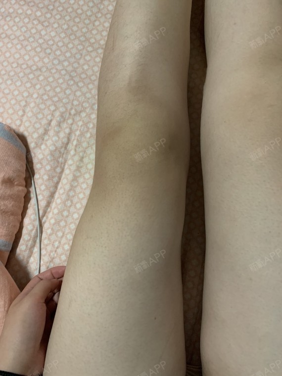 膝盖上方向外突出,一用力更加明显,显得腿不大直,有点小着急
