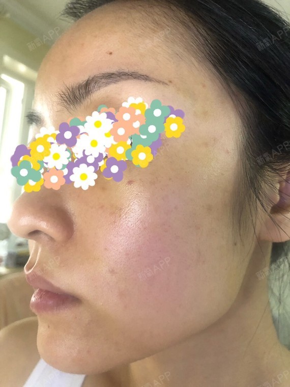 水光针