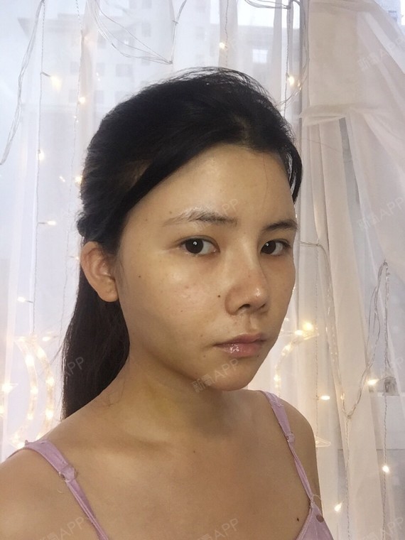 北京面部吸脂好不好_效果图_氧气2q2of面部吸脂术后第