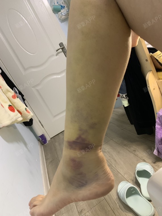 吸脂瘦小腿