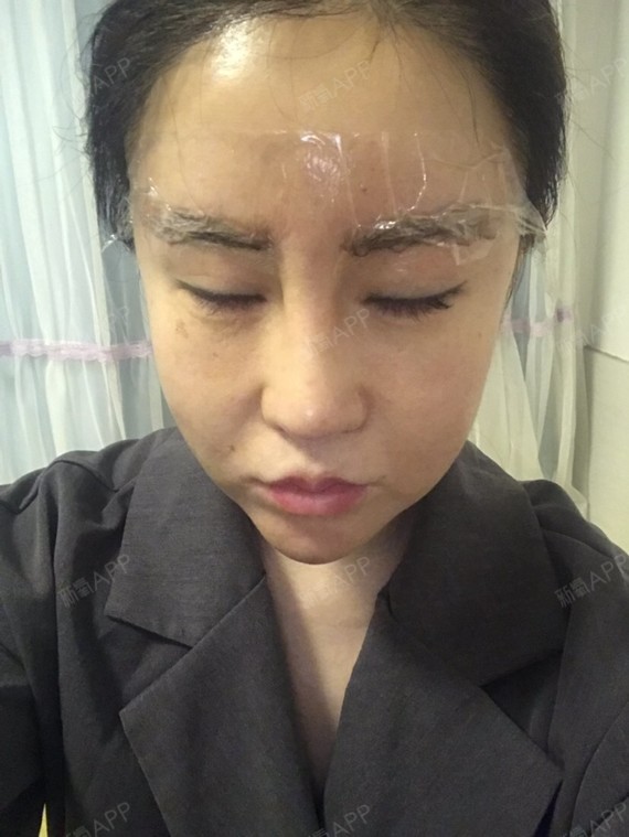 取颊脂垫瘦脸