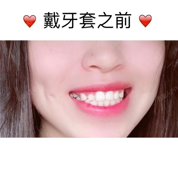 戴金属托槽牙套的对比图来啦