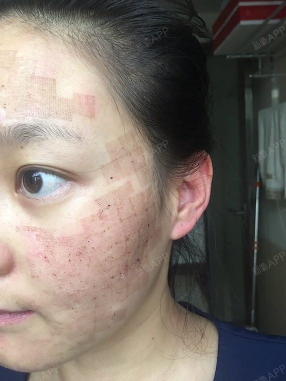 脸上结痂了,冒了一点小白头,做治疗的地方都涂上了生长因子