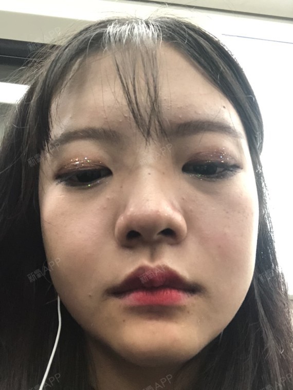 v-line瓜子脸手术