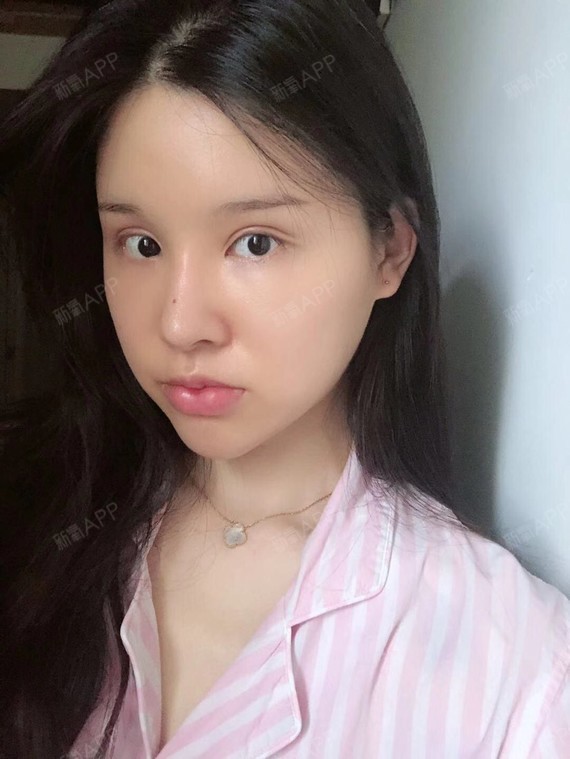 m唇手术