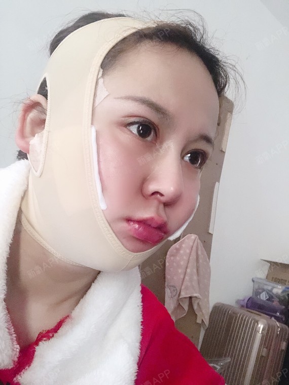 面部吸脂