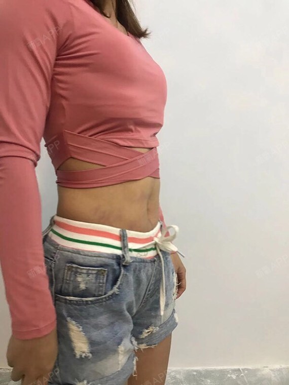 腰腹环吸,目前还有一点淤青,小肚子完全瘦下来的,健身卡可以丢一边去