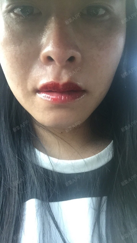 下嘴唇脱痂比较快,目前颜色是很粉嫩的颜色,医生说过段时间还有返色期