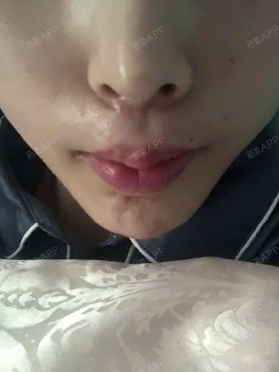 人中歪到另个鼻孔了 两周了 额头的疤