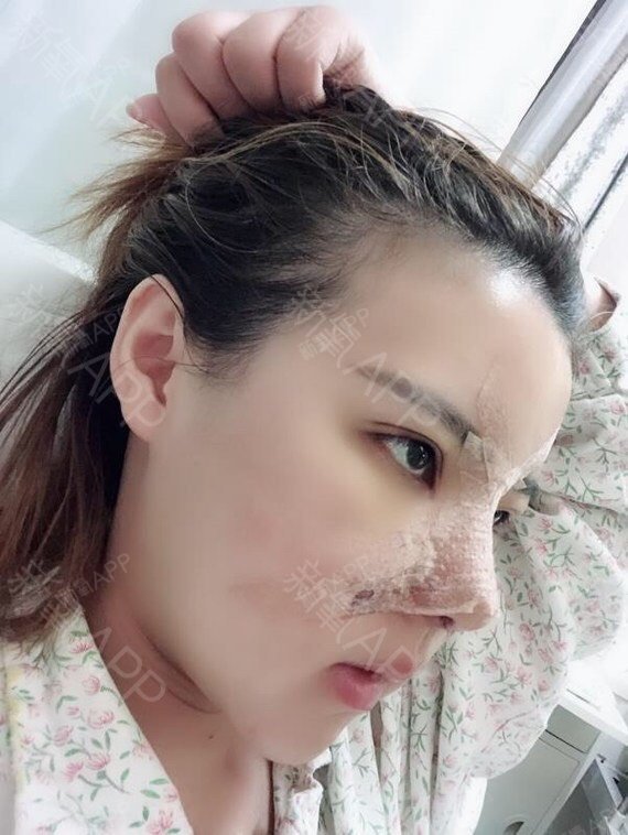 第一天真是肿到眼睛都睁不开,只能慢慢等慢慢熬,鼻子疼肋骨也