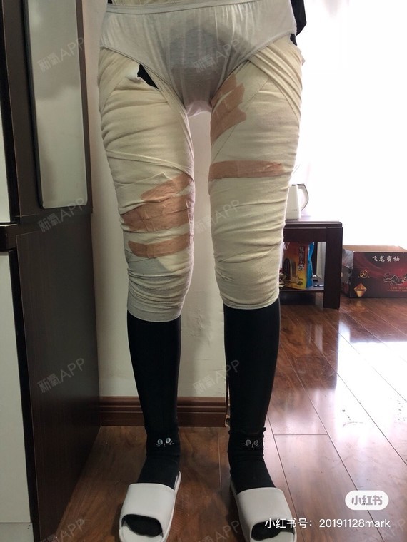 大腿抽脂第五天啦,已经不疼啦,拆掉塑身裤外面护士给_圈子-新氧美容