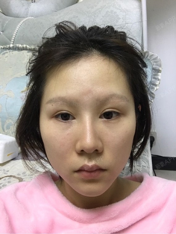 下眼下至术