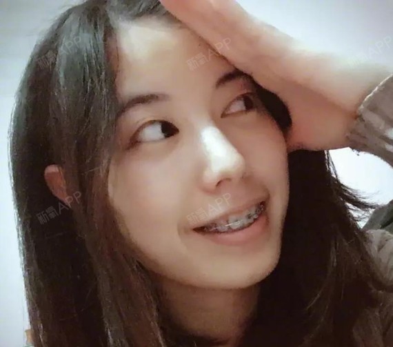 刚带牙套两个月后牙被垫高,咀嚼无力,出现牙套脸了,_圈子-新氧美容
