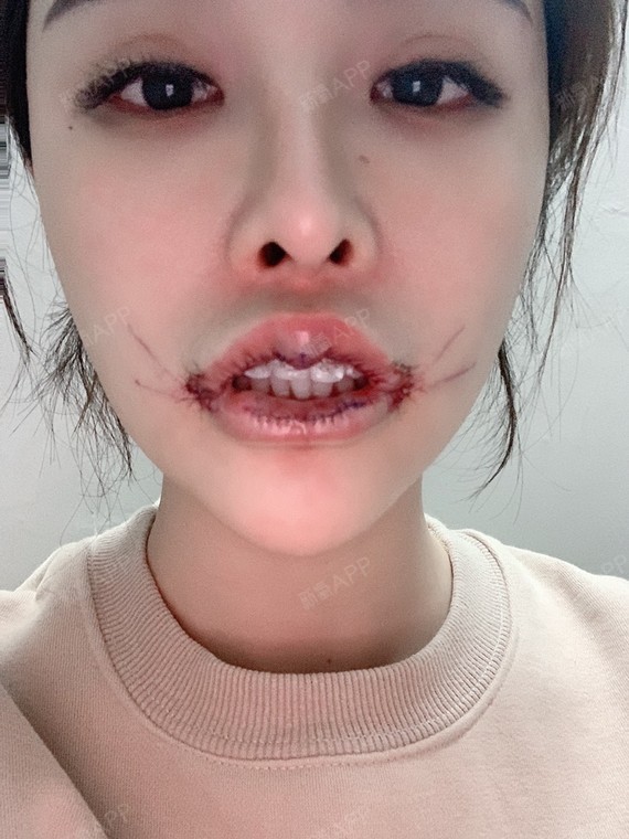 m唇手术