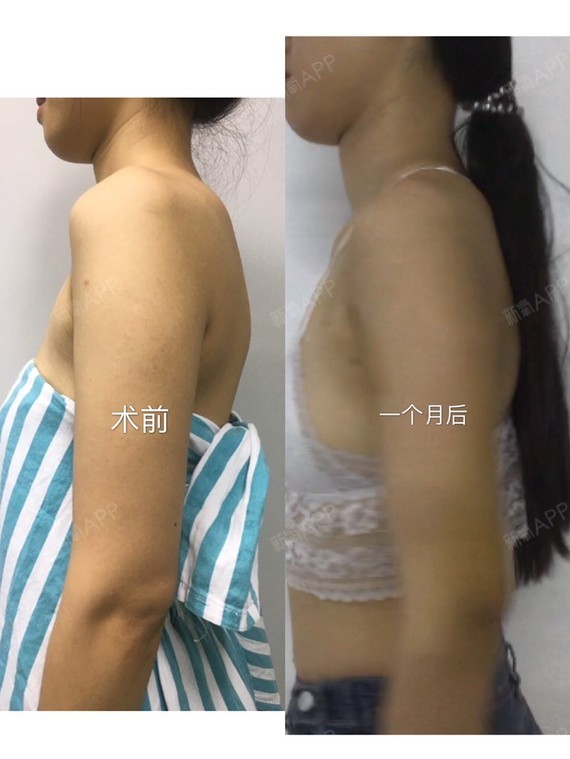 广州吸脂瘦手臂好不好_效果图_氧气_mdc4678e8吸脂瘦