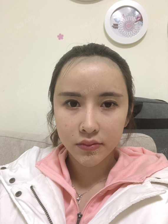 假体填充额头