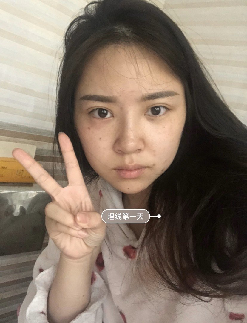 埋线双眼皮怎么样_恢复过程_效果如何_梁大静静dd整形