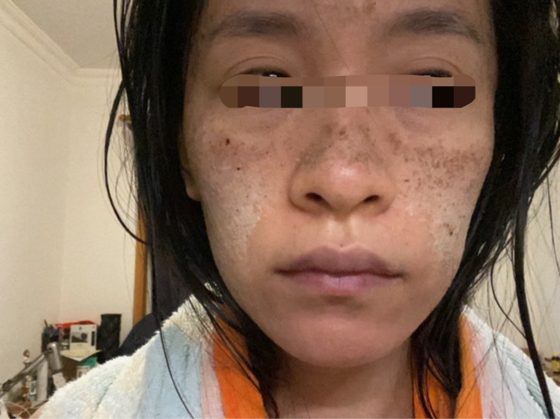 点阵激光第10天