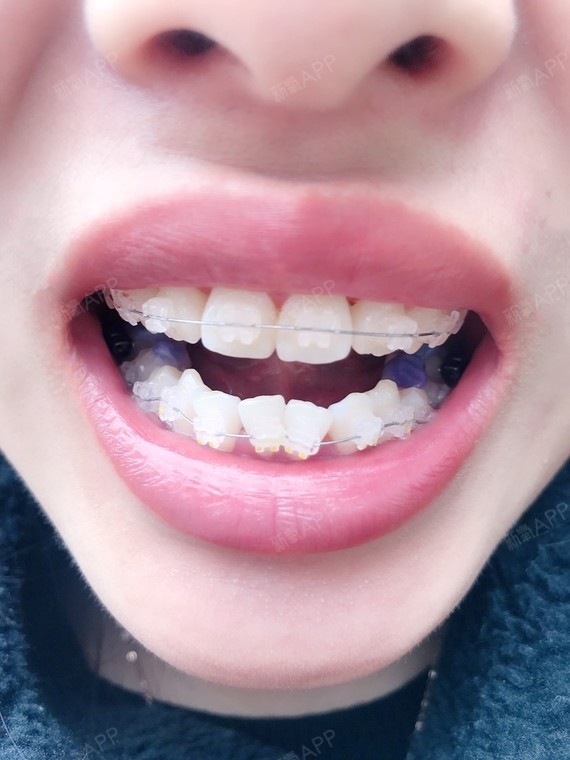 嘴巴里蓝色的就是垫高的,垫了下牙6颗里面的牙齿