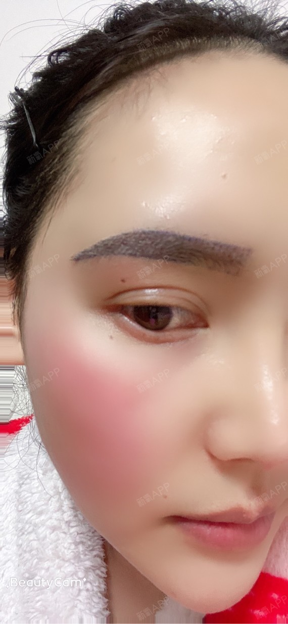 种植眉毛