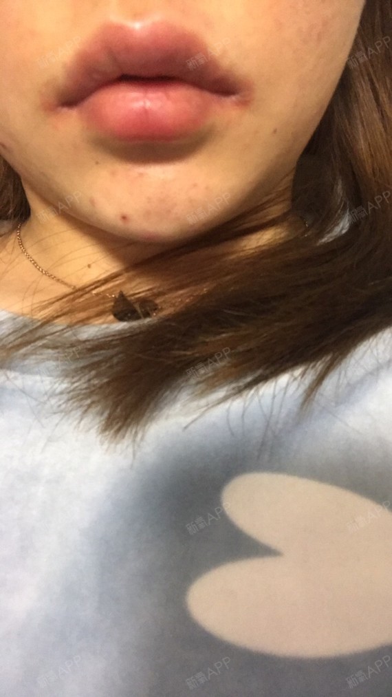 嘟嘟唇才打完三小时后