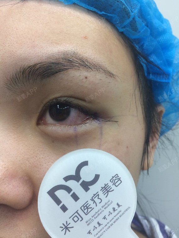 深圳埋线双眼皮好不好_效果图_氧气6h64l埋线双眼皮术