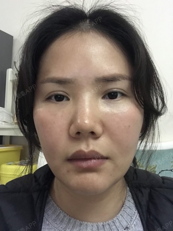 取颊脂垫瘦脸好不好_效果图_六分大大取颊脂垫瘦脸术9
