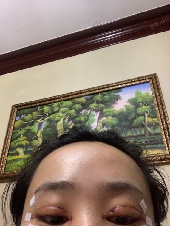 乌鲁木齐开内眼角好不好_效果图_氧气9q7fq开内眼角术