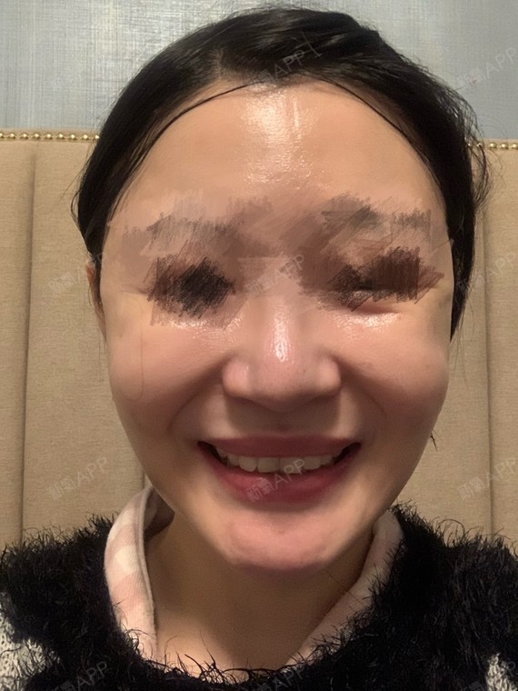 面部吸脂好不好_效果图_面吸的小可怜面部吸脂术后第