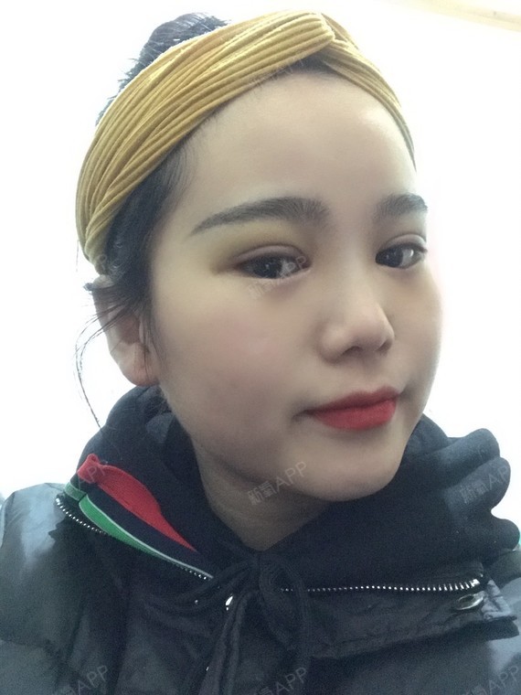 开内眼角好不好_效果图_氧气9r32p开内眼角术后第29天