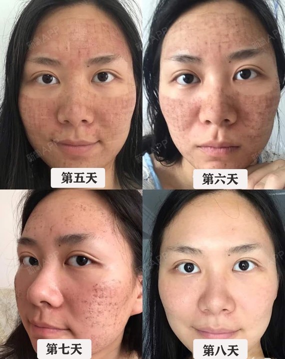 96跟大家分享一下我做二氧化碳点阵激光的经历,照片上_圈子-新氧