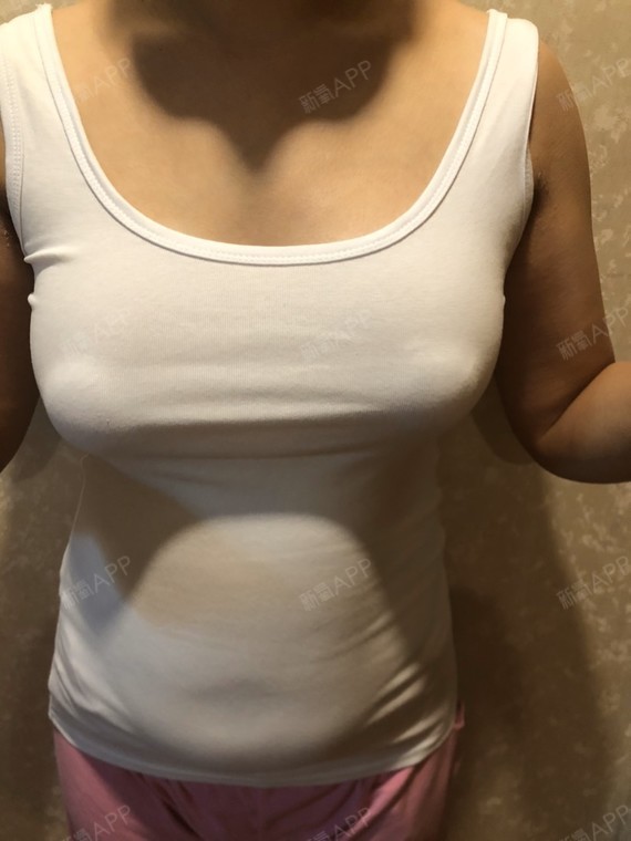 假体隆胸好不好_效果图_氧气nbco0e5d5假体隆胸术后第