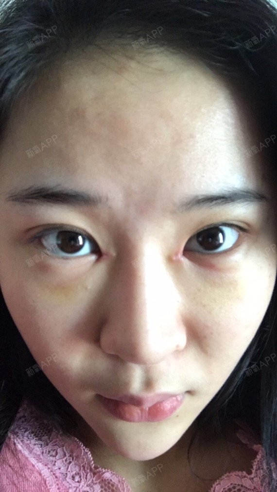我的内眼角括号疤痕比较明显,而且开了内眼角后眼间距_圈子-新氧美容