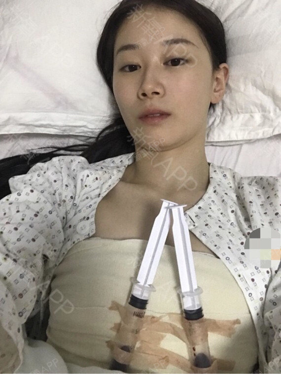 假体隆胸