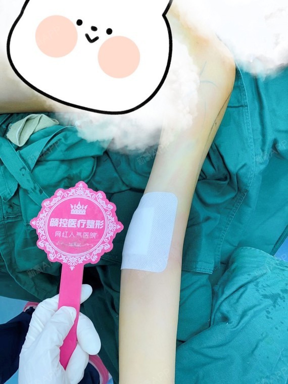 吸脂去副乳