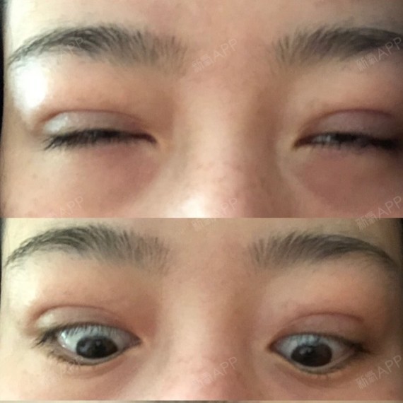 武汉切开双眼皮好不好_效果图_氧气23tfj切开双眼皮术