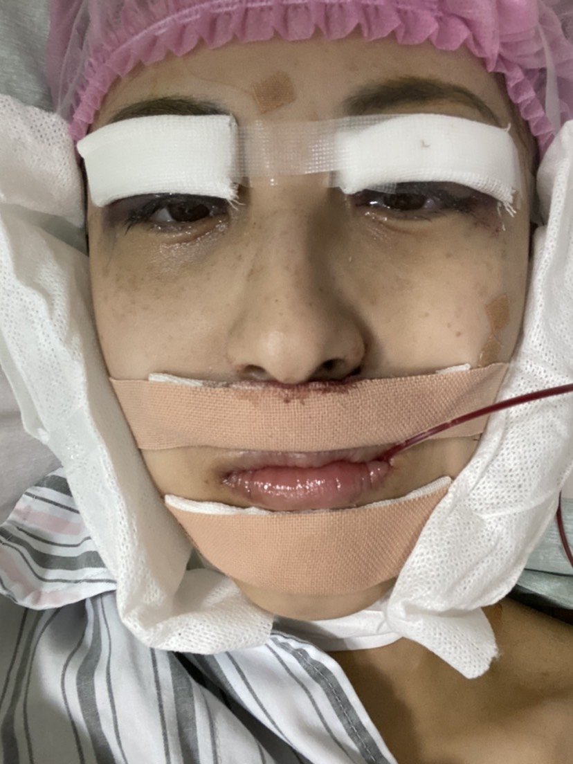 上海长征医院整形外科上下颚手术/突嘴矫正怎么样___f