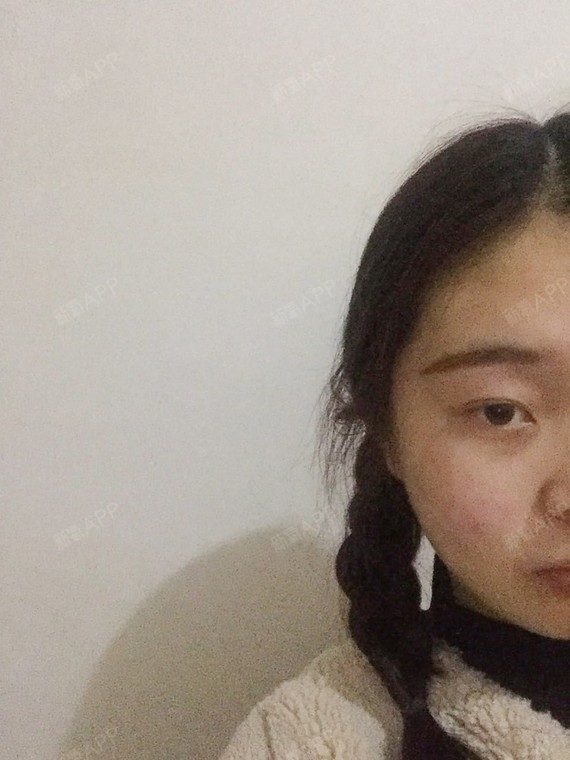 济南激光去胎记好不好_效果图_暖暖房东激光去胎记术