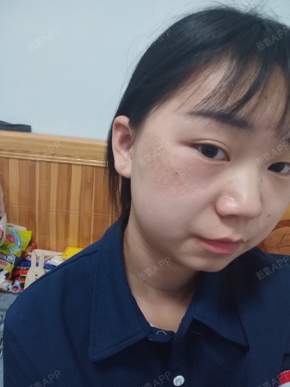 上海激光去胎记好不好_效果图_顺其自然的2020激光去