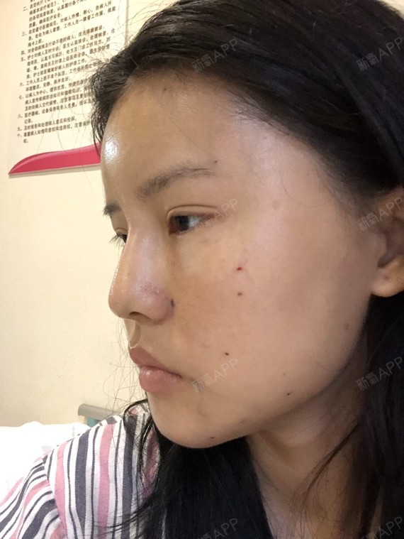术前面诊了几家,也做了挺多功课的,因为本身面部凹陷