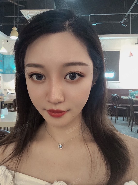 玻尿酸填充面颊