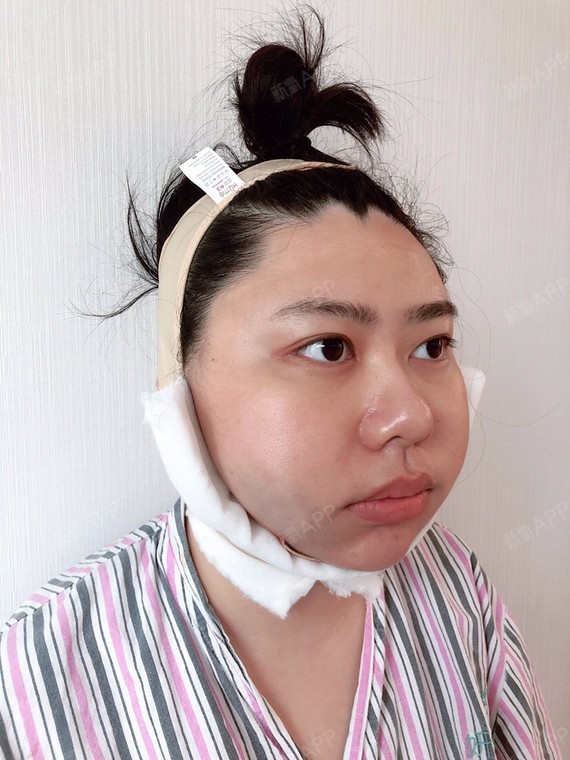 取颊脂垫瘦脸好不好_效果图_茹萍姐姐取颊脂垫瘦脸术2