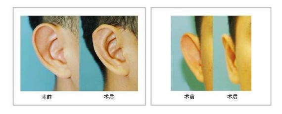 【招风耳算不算病?】生活中少数人的耳朵向头颅两侧突
